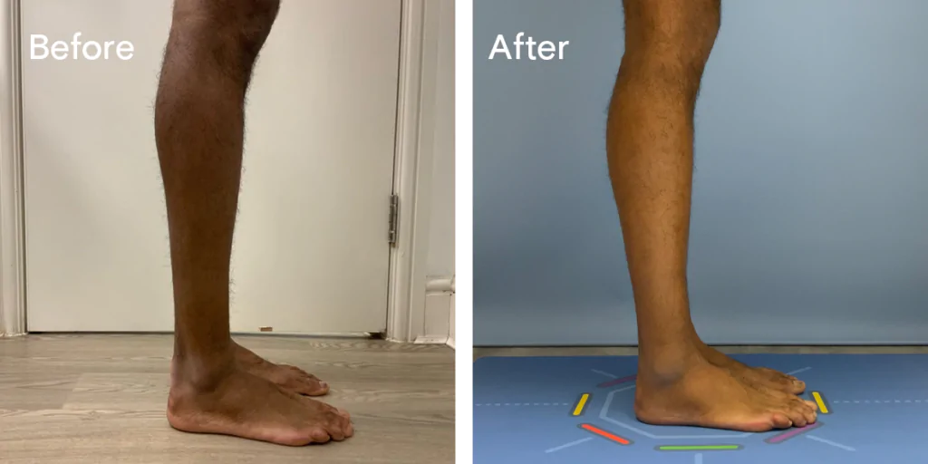 Calf augmentation enhances the shape and volume of the calves for a more masculine contour, through the use of medical-grade silicone implants, fat transfer, or a combination of both methods. Calf Implants And Augmentation For Trans Men &Amp; Nonbinary Individuals